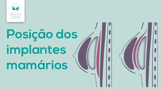 Posição das próteses: por que existem formas diferentes de colocar os implantes?