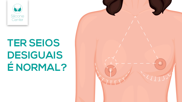 Qual mama é maior? O silicone corrige seios desiguais?