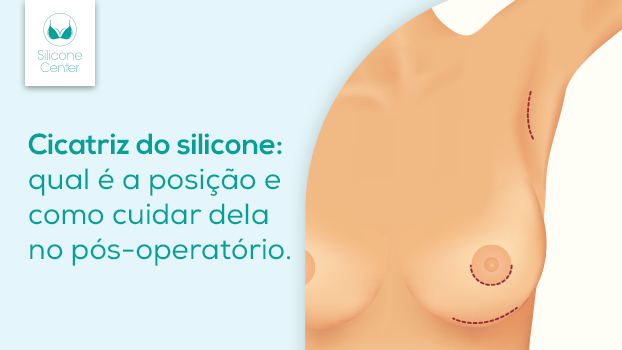 Cicatriz do silicone: qual é a posição? Como cuidar no pós-operatório?