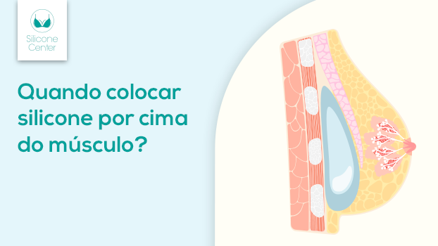Quando colocar silicone por cima do músculo? Descubra quais são as indicações