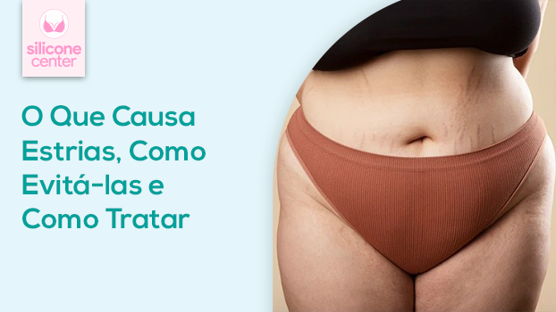 O Que Causa Estrias, Como Evitá-las e Como Tratar