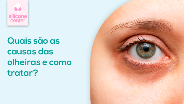 Olheiras: quais são as causas? Como tratar?